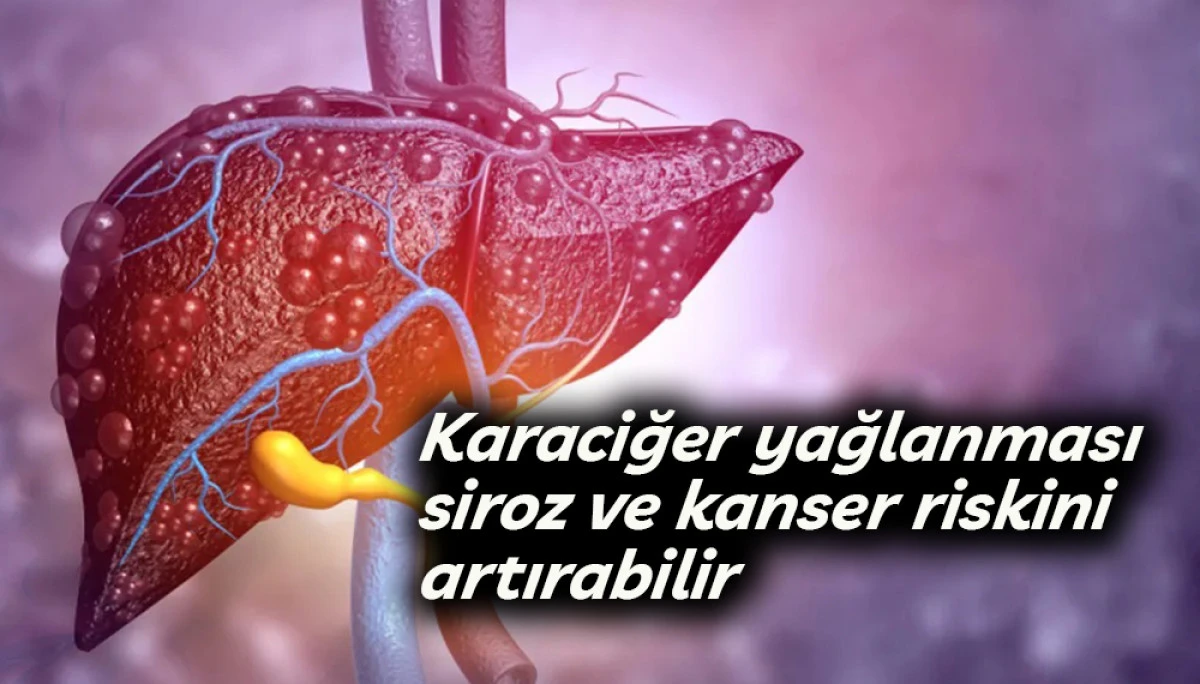 Karaciğer yağlanması siroz ve kanser riskini artırabilir